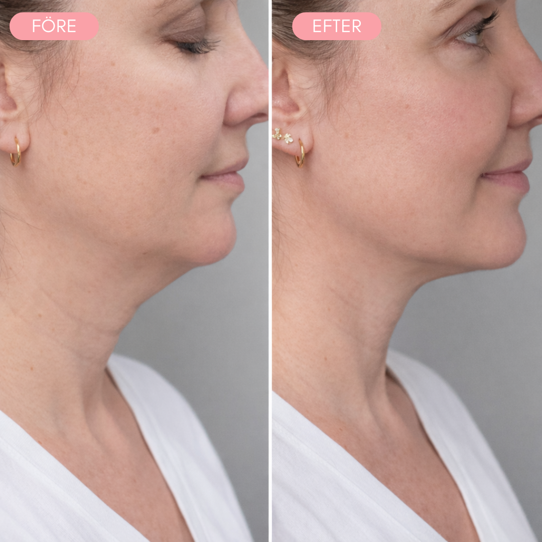 SkinLift™ – Intensiv Halsmask för Fastare Hud & V-Line Effekt