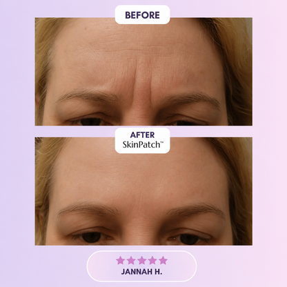 SkinPatch™ – Silikonplåster för Rynkor & Ärr