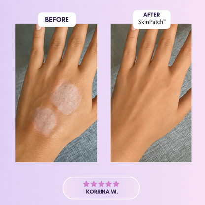 SkinPatch™ – Silikonplåster för Rynkor & Ärr