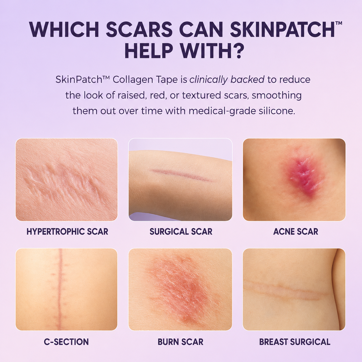 SkinPatch™ – Silikonplåster för Rynkor & Ärr