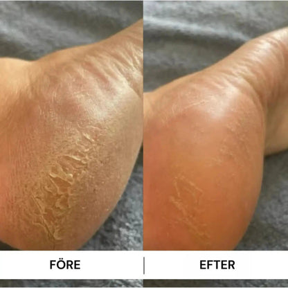 HeelFix™ – Reparerande Fotstick för Spruckna Hälar & Silkeslena Fötter