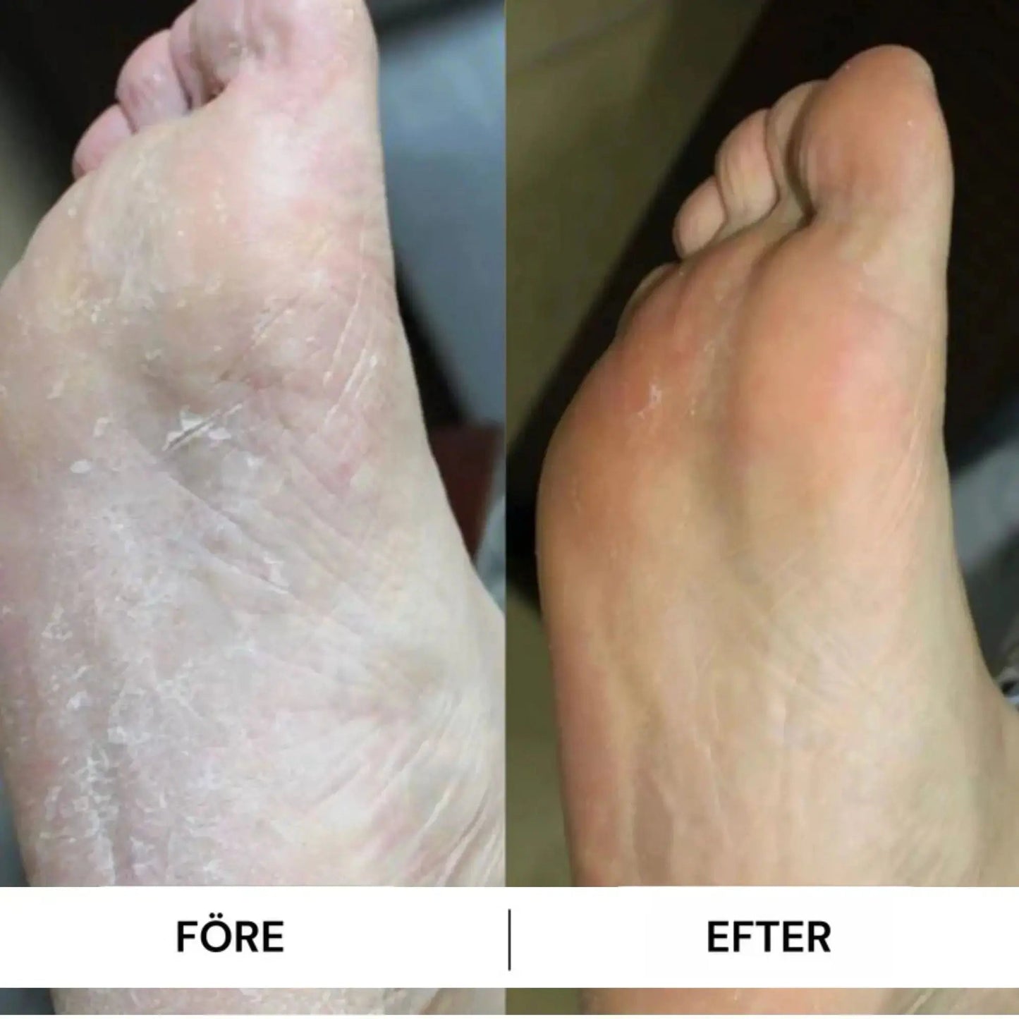 HeelFix™ – Reparerande Fotstick för Spruckna Hälar & Silkeslena Fötter