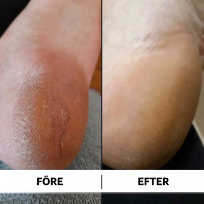 HeelFix™ – Reparerande Fotstick för Spruckna Hälar & Silkeslena Fötter