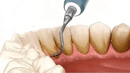 Dentify™ – Elektrisk Tandstensborttagare för Renare & Friskare Tänder Hemma
