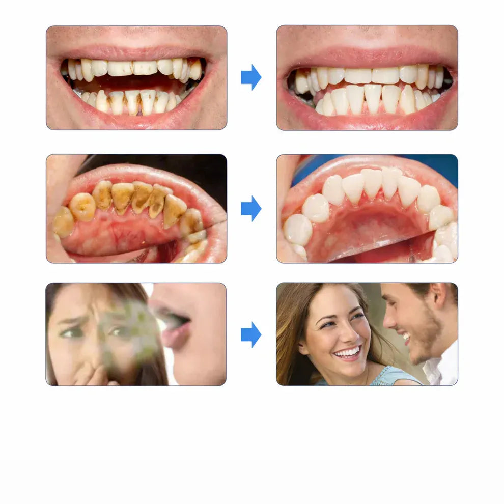 Dentify™ – Elektrisk Tandstensborttagare för Renare & Friskare Tänder Hemma