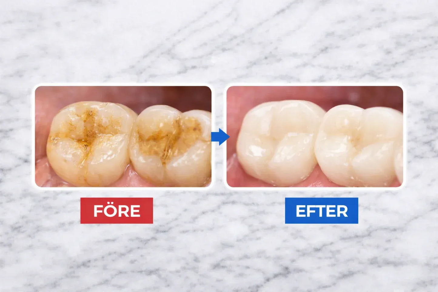 Dentify™ – Elektrisk Tandstensborttagare för Renare & Friskare Tänder Hemma