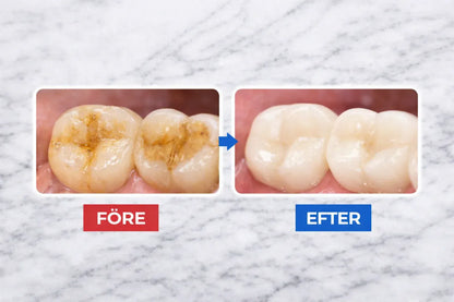 Dentify™ – Elektrisk Tandstensborttagare för Renare & Friskare Tänder Hemma