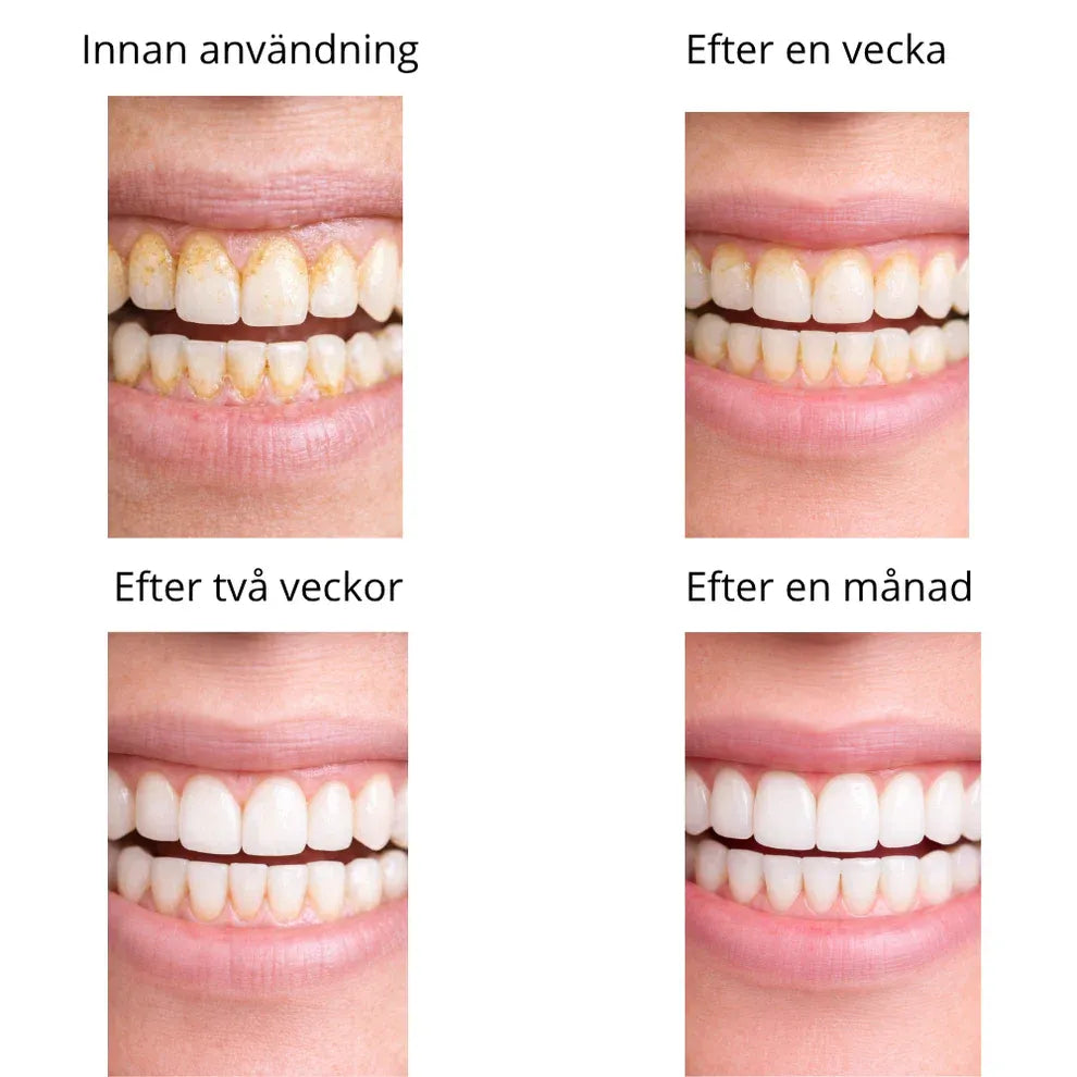Dentify™ – Elektrisk Tandstensborttagare för Renare & Friskare Tänder Hemma