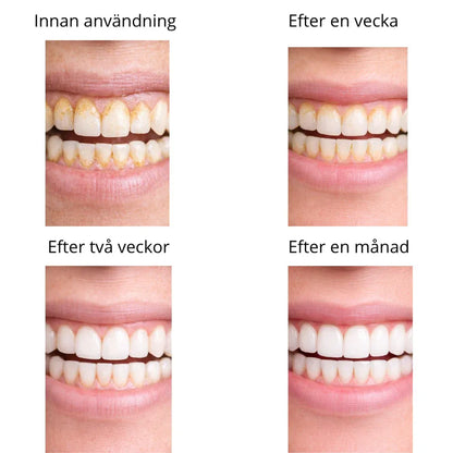 Dentify™ – Elektrisk Tandstensborttagare för Renare & Friskare Tänder Hemma